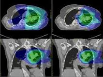 Image result for where are protons cancer treatment centers located