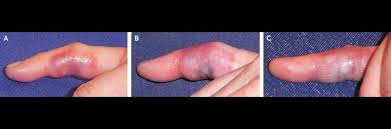 Image result for yellow sac spider bite skin