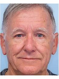 Endoscopic Browlift2* 896