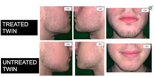 Image result for Minoxidil