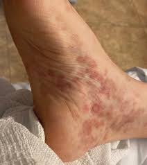 Image result for brown patches on the feet