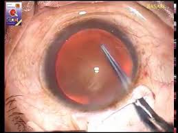 Small Incision Cataract Extraction Sics Dr Samar Basak Youtube