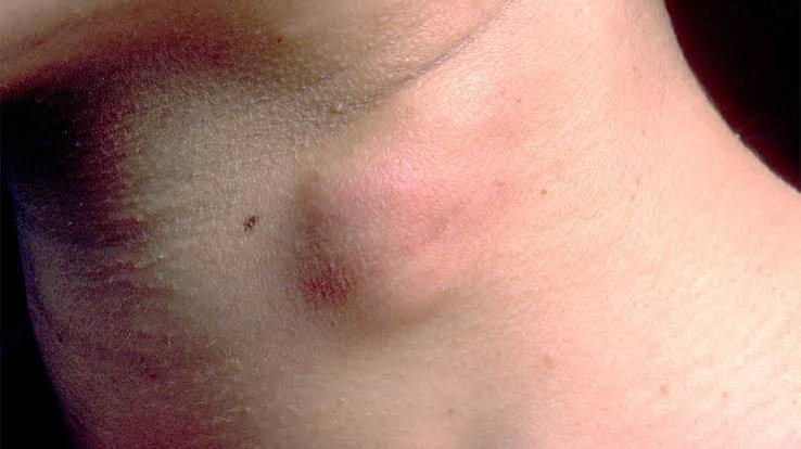 What Is a Skin Lump? Symptoms, Causes, Diagnosis, Treatment, and More