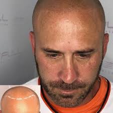 FULL MICROPIGMENTATION