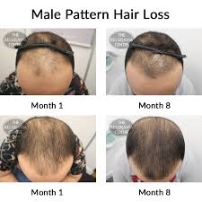 When you have male pattern baldness, the hair follicles in your scalp become inflamed. The Belgravia Hair Loss Centre This Male Pattern Hair Loss Client Is Showing Great Improvement And Says He Would Definitely Recommend To Others See His Full Success Story Here Https Www Belgraviacentre Com Success Stories Hair Growth Success