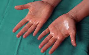 Image result for Hyperhidrosis Causes