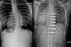 Rope Or Rod Torn Between Scoliosis Surgery Whyy