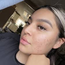 TOP 10 BEST Acne Facial near Montclair, CA