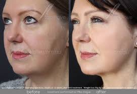 Double Chin Fat Dissolving Injections Melbourne Facelove