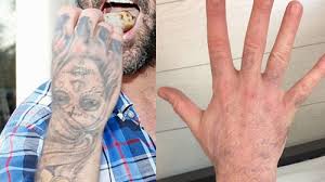 After tattoo removal care laser tattoo removal is the only safe and effective procedure for removing unwanted tattoos. Have You Considered Laser Tattoo Removal Accidental Hipster Mum