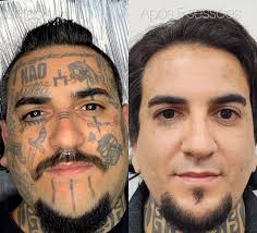 Amazing tattoo removal 🔥 🔥 🔥