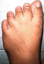 Image result for Onychotillomania feet