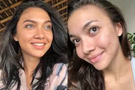 Sampai sekarang, belum ada keterangan jelas soal penyebab. Tak Enak Hati Selalu Disebut Sempurna Oleh Netizen Angela Gilsha Perlihatkan Wajahnya Yang Berjerawat Dan Giginya Yang Kuning Semua Halaman Nova