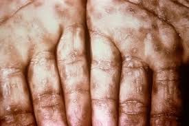 Image result for syphilis symptoms