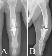 Swanson health products (shp) is a natural health catalog and internet marketing company headquartered in fargo, north dakota. Proximal Interphalangeal Joint Arthroplasty With Tactys Clinical And Radiographic Results With A Minimum Follow Up Of 12 Months Sciencedirect