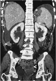 If your doctor suspects that you have cancer near your abdomen, they may recommend an abdomen ct scan. Ct In Ovarian Cancer Staging How To Review And Report With Emphasis On Abdominal And Pelvic Disease For Surgical Planning Cancer Imaging Full Text