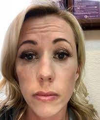 How long does botox last? Sparkles And Lattes My Experience With Botox