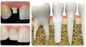 If they do become loose, you need to contact us as soon as possible so we can place them back into place. How Long Does It Take For Dental Implants To Heal