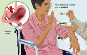 A biopsy is the only way to confirm cancer. Gastric Cancer Physiopedia