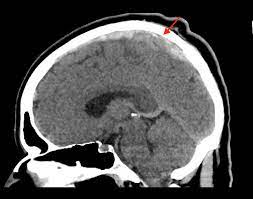 It's most common clinical manifestations are headache, seizures. Cureus Superior Sagittal Venous Sinus Thrombosis In A Patient With Illicit Testosterone Use