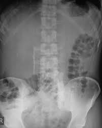 There Are Stones And Then There Are Stones This Is A Gigantic Ureteric Stone See The Complete Case Http Radiopaedia Org Cases Radiology Cool Tools Stone