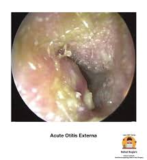 Image result for Acute Otitis Externa