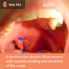 Image result for Peritonsillar Abscess