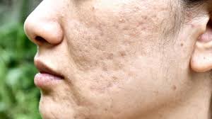 Cara menghilangkan bekas jerawat menggunakan madu yang pertama dengan cara oleskan madu ke wajah. Cara Menghilangkan Bopeng Bekas Jerawat Dengan Bahan Alami Ampuh Banget Hot Liputan6 Com