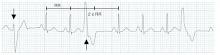 Image result for what is the icd 10 code for pvc
