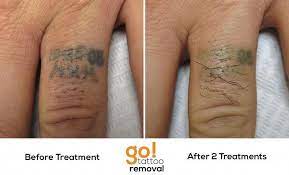 This Client Came To Us After Several Attempts At Having This Tattoo Covered With Flesh Colored And White Tattoo Cover Tattoo Laser Tattoo Removal White Tattoo