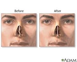 Chronicles of Sleep Apnea, Lung Health and Septoplasty