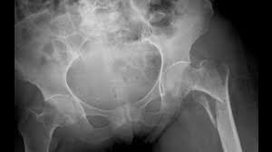 Dxa is most often used to diagnose osteoporosis, a condition that often affects women after menopause but may also be found in men. Test Osteoporoza Pret Divahair Ro