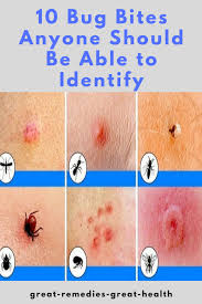 10 Bug Bites Anyone Should Be Able To Identify In 2020 Bug Bites Identifying Bug Bites Infected Bug Bite
