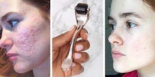 Lieferung in 1 bis 3 werktagen. Microneedling Dermaroller Vorher Nachher Vergleiche Die Galerie