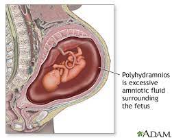 Pregnancy Health Center Hydramnios