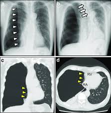 Pneumothoraces) refers to the presence of gas (often air) in the pleural space. Electrocardiographic Manifestations In A Large Right Sided Pneumothorax Bmc Pulmonary Medicine Full Text