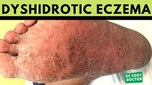 Image result for pompholyx soles of feet