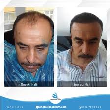 Anatolia Sac Ekim Guvencesi Ve Yeliz Damar Tecrubesi Ile Tum Operasyonlar Basariyla Sonuclanmaktadir Harika Sonuclar Icin Oncesi Sonrasi Pay Sac Ekim Yelken