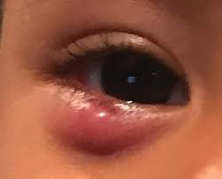 Mosquito bite on eyelid baby. Take Your Lumps