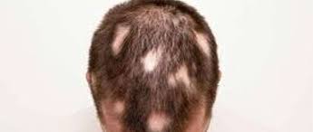 Iron deficiency anaemia and hair loss. Male Baldness Causes And Treatment Methods Ilajak Medical
