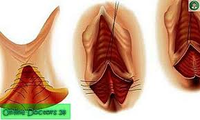 Seorang ibu yang baru 7 hari bersalin dirujuk kepada dr hana dengan episiotomy wound gapping. Pecah Perineum 2 Darjah Jenis Penyebab Penutupan Dan Pencegahan Wanita Kesihatan 2021
