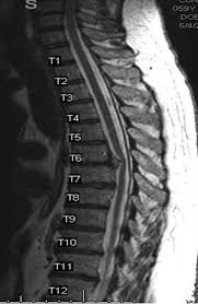 Pin On Thoracic Spine Fusion