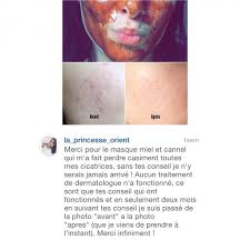 Masque Anti Points Noirs Ou Pores Dilates Point Noir Masque Anti Point Noir Pores Dilates