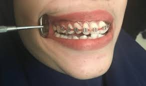 We did not find results for: Fitted Fake Braces With No Orthodontic Molar Band And Inaccurate Download Scientific Diagram