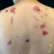 Image result for Pemphigus