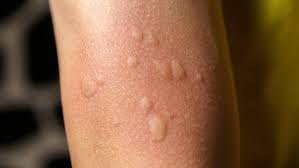 Image result for mosquito bite