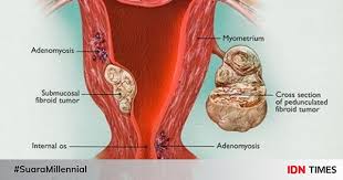 Tumor ini sering muncul di rahim dan disebut fibroid rahim, polip rahim , atau miom. Fibroid Uterine Penyebab Jenis Gejala Dan Pengobatan