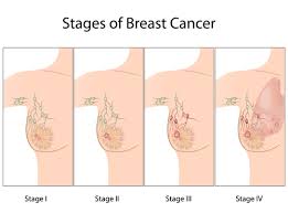 Image result for Breast Cancer Staging