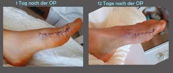 Dass der ballenzeh als schönheitsfehler empfunden wird, sollte nie alleiniger grund für eine tiefgreifende operation sein. 13 Tage Nach Meiner Hallux Valgus Op Ezris Kleine Welt