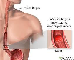 Esophagitis Is Inflammation That May Damage Tissues Of The Esophagus The Muscular Tube That Delivers Food From Your Mouth To You Esophagitis Ulcers Ulcer Diet